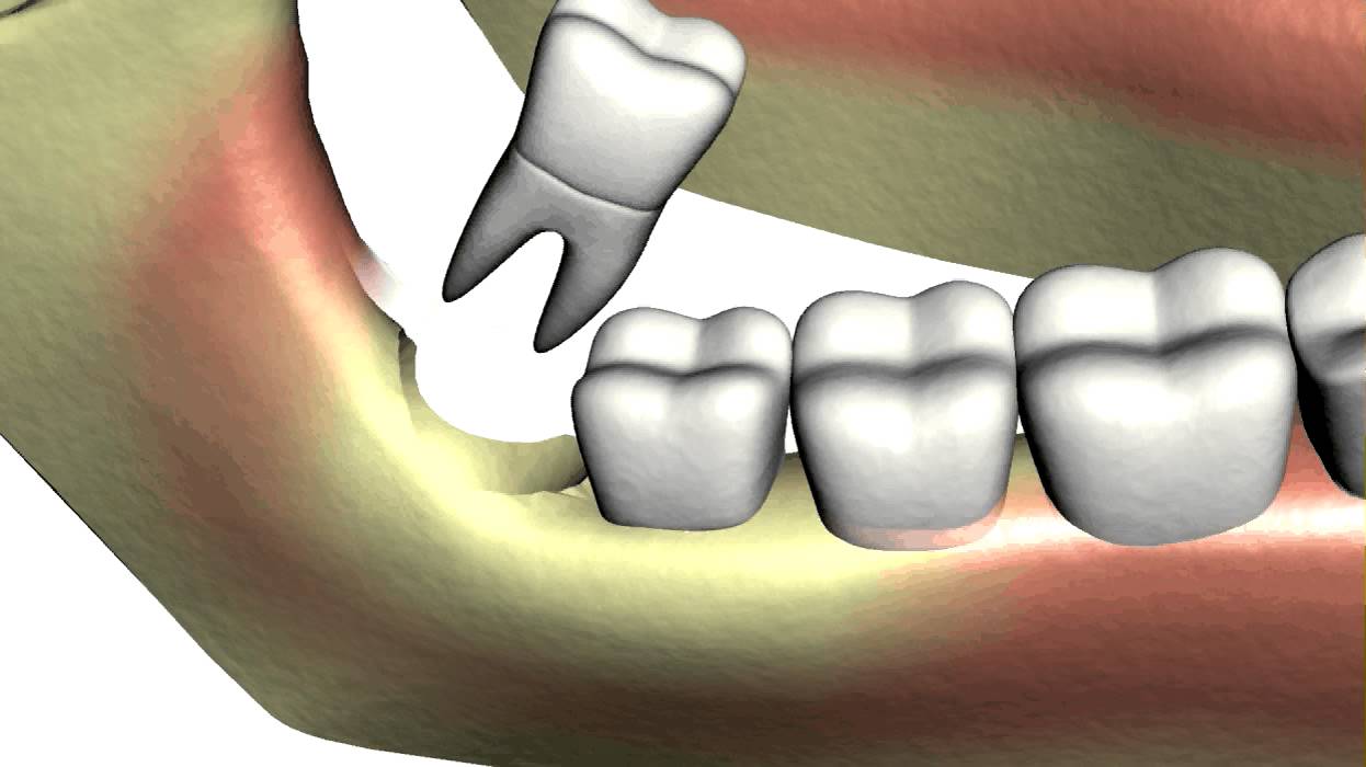Tooth extraction. Альвеолит в стоматологии. Ретинированный зуб мудрости.