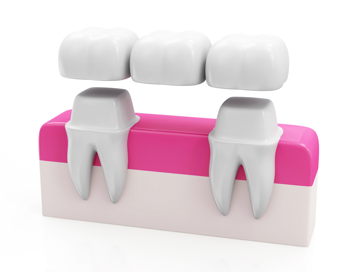 dental-bridges-2