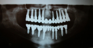 Implants dentaires, le róle de l'implantation - Implantcenter dentisterie - Budapest, Hongrie