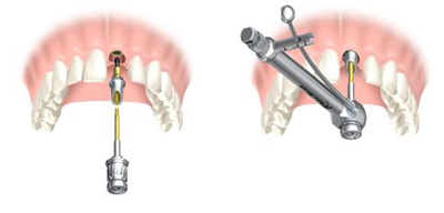 Pose de l'implant dentaire - Implantcenter